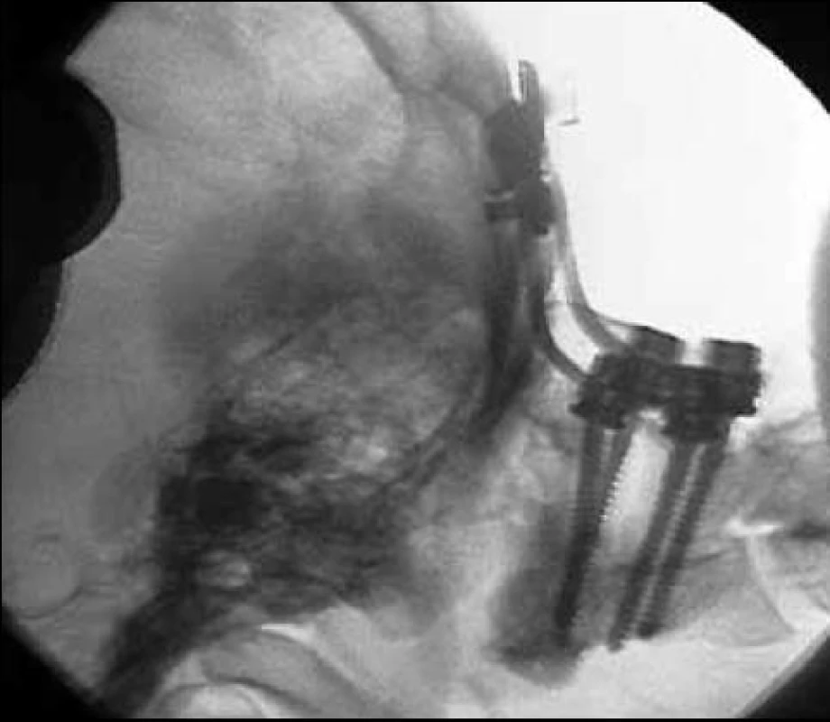 Pooperační snímek pacientky, která podstoupila zadní stabilizaci C2–C0 pro AOD.