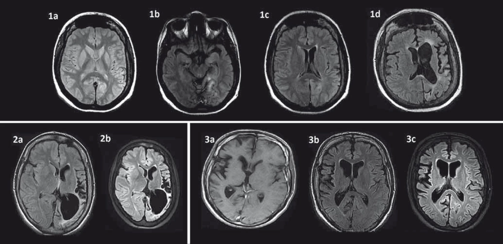 Časový vývoj MR zmien u troch pacientov s Rasmussenovou encefalitídou.
1a: T2W MR mozgu vo veku 24 rokov v čase prvého status epilepticus bez jasných atrofických zmien u pacientky s parciálnymi záchvatmi od 16 rokov; 1b: FLAIR MR s hyperintenzívnym signálom temporookcipitálne vľavo vo veku 29 rokov u tej istej pacientky; 1c: FLAIR MR incipientná atrofia v oblasti caput nuclei caudati vľavo vo veku 29 rokov u tej istej pacientky; 1d: FLAIR MR vo veku 34 rokov výrazná progresia atrofie ľavej mozgovej hemisféry s klinickou progresiou do reziduálneho štádia s ťažkou pravostrannou spastickou hemiparézou a afáziou, prevažne expresívnou, vyhasínanie epileptických záchvatov; 2a: FLAIR MR u 25-ročnej pacientky s dominujúcou atrofiou posteriórne vľavo s anamnézou parciálnych záchvatov od 6 rokov, prekonaným prvým status epilepticus vo veku 20 rokov s aktívnou epilepsiou a minimálnym neurologickým deficitom; 2b: FLAIR MR vo veku 28 rokov výrazná progresia atrofie v oblasti ľavej hemisféry dominujúca parietookcipitálne, minimálny neurologický deficit; 3a: FLAIR MR u 19-ročného pacienta s ľahkou atrofiou predominantne centrálne v oblasti pravej hemisféry (prvé parciálne záchvaty vo veku 17 rokov a prvý status epilepticus vo veku 18 rokov); 3b: FLAIR MR – 31-ročný – malá progresia atrofie centrálne vpravo (pre ťažkú farmakorezistetntnú epilepsiu s minimálnym neurologickým deficitom po zlyhaní predošlej imunoterapie indikovaný na biologickú liečbu rituximabom); 3c: FLAIR MRI – 34-ročný – v MR bez výraznejšej progresie atrofie pravej hemisféry, tri roky stabilizovaný na liečbe rituximabom (sporadické parciálne záchvaty, bez progresie neurologického deficitu).
Pozn.: Prezentované so súhlasom Rádiologickej kliniky LF UK, SZU a UN Bratislava, Nemocnica ak. L. Dérera.
Fig. 1. Time evolution of MRI changes in three patients with Rasmussen’s encephalitis.
1a: T2W MRI of a 24-year-old female patient following the first status epilepticus, no brain atrophy (first partial seizures occurred at the age of 16 years); 1b: FLAIR MRI – hyperintense signal in the temporal-occipital region on the left in the same patient aged 29; 1c: FLAIR MRI – incipient atrophy in the region of caput nuclei caudati on the left in the same patient aged 29; 1d: FLAIR MRI of the same patient aged 34 with marked progression of atrophy of the left hemisphere; 2a: FLAIR MRI with brain atrophy predominantly in the posterior region of the left hemisphere in a 25-year-old patient (the first epileptic seizure at 6 years of age, the first status epilepticus at 20 years of age) with active epilepsy and minimal neurologic deficit; 2b: FLAIR MRI at 28 year of age with marked progression of the left hemisphere atrophy, predominantly in the posterior region, minimal neurological deficit; 3a: FLAIR MRI in a 19-year-old patient with mild atrophy of the right hemisphere in the central region (first seizures as a 17-year-old, the first status epilepticus as an 18-year-old); 3b: FLAIR MRI – 31-year-old with mild progression of the brain batrophy on the right (due to severe refractory epilepsy and mild neurological deficit, started biological treatment with rituximab after failure of previous immunotherapy); 3c: FLAIR MRI – 34-year-old – only mild progression of the right hemisphere atrophy, three years under rituximab, epilepsy under control (sporadic partial seizures without neurological decline).
Note: with the agreement of the Dept. of Radiology, Medical Faculty Comenius University and University Hospital, Dérer´s Hospital, Bratislava.