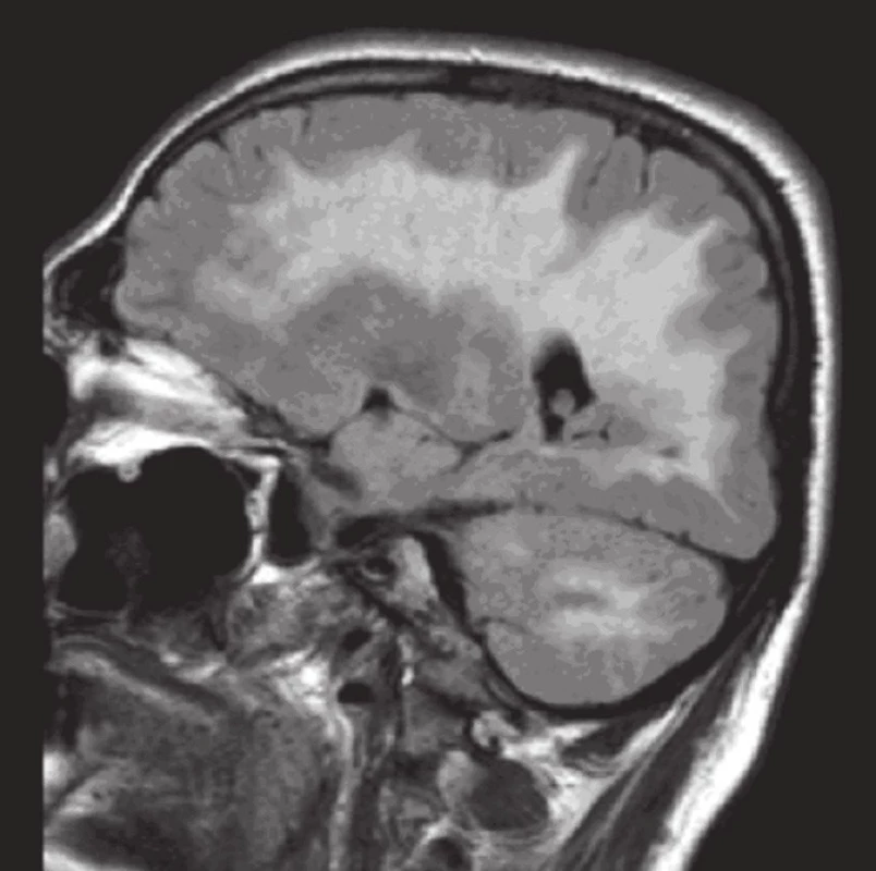 MR mozku: FLAIR sagitálně (tři dny po vzestupu TK): plošné patologicky zvýšený signál bílé hmoty zachycené mozkové i mozečkové hemisféry.