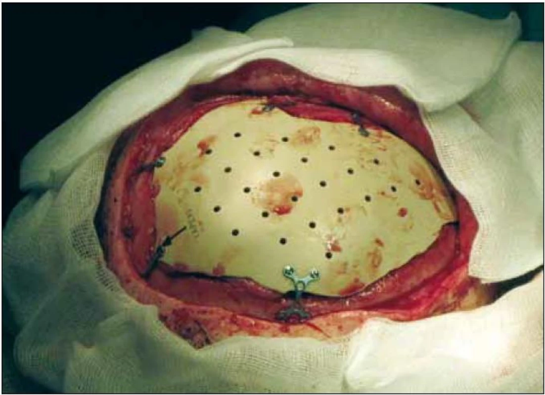 Usazení implantátu – biokompatibilní implantát přesně vyplňuje kostní defekt, a obnovuje tak anatomické kontury. Je pevně přichycen titanovými dlažkami a šrouby.