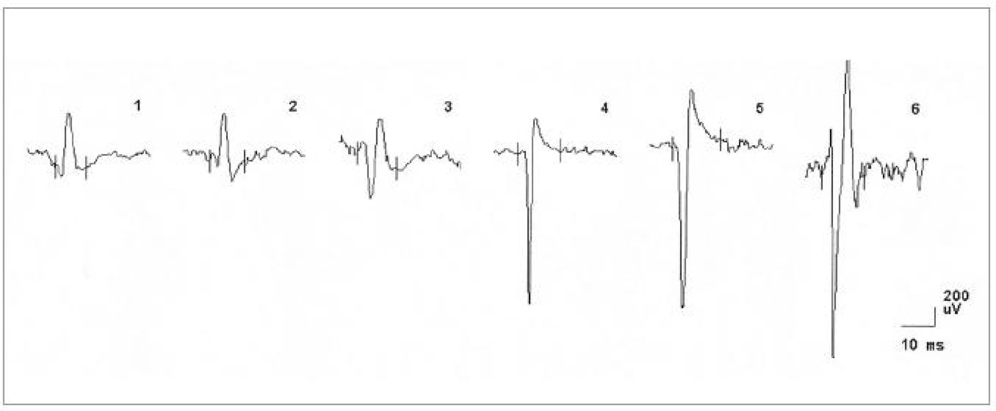 EMG nález při vyšetření musculus vastus medialis vpravo u pacientky č. 1, dokumentující změny v obraze motorických jednotek neurogenního typu (vysoká amplituda MUP, polyfázie).