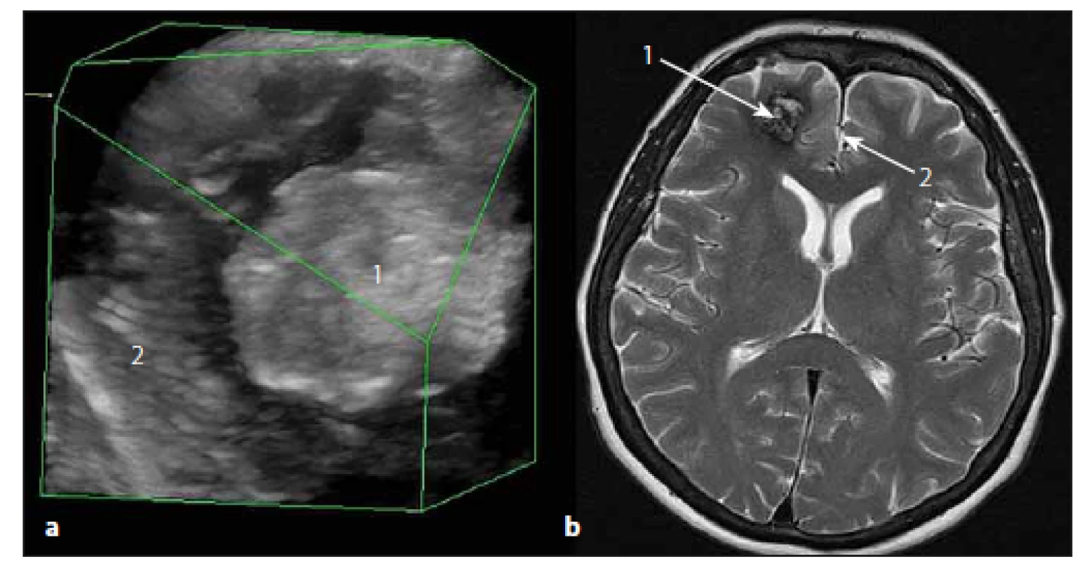 Sonografický 3D obraz kavernomu čelního laloku vpravo.
Fig. 5. The ultrasound 3D image of right frontal lobe cavernoma.