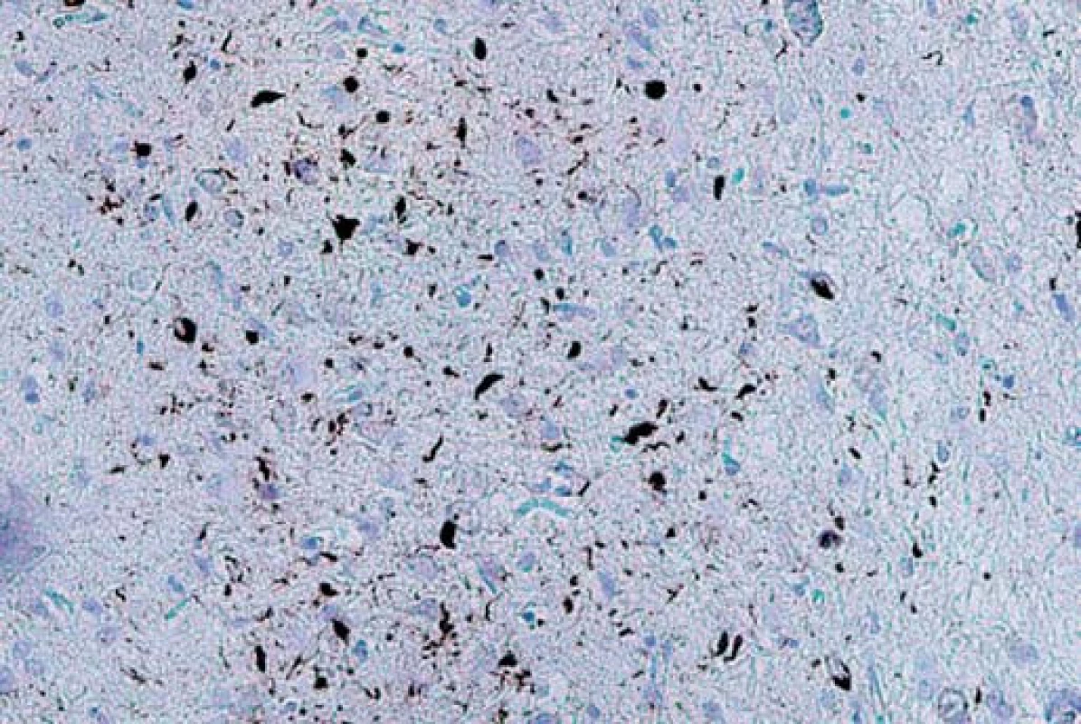 Dystrofické neurity a neuronální cytoplazmatické inkluze (NCI) v 2. vrstvě frontálního kortexu v imunohistochemickém barvení P-TDP-43. Typ A.
Fig. 3. Dystrophic neurons and neuronal cytoplasmic inclusions (NCI) in the second layer of the frontal cortex on immunohistochemical staining of P-TDP-43. Type A.