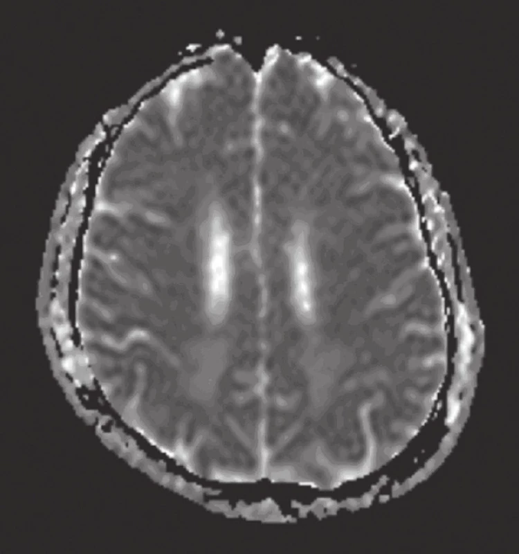 MR mozku: difuzně vážený obraz – ADC mapa (v odstupu jednoho měsíce): regrese hyperintenzity vazogenního edému, který přetrvává zčásti oboustranně okcipitálně.