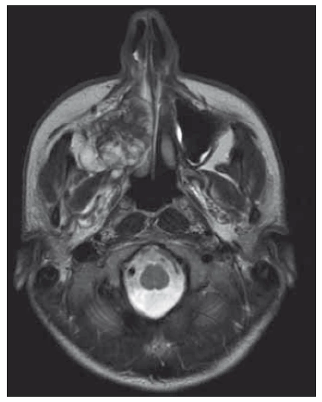 MRI transverse view – sarcoma in
the right maxilla, obstructing right part of
nose, deviating nasal septum and expanding
into infratemporal fossa.<br>
Obr. 2. MR příčný/transverzální pohled –
sarkom v pravé maxile, obstrukce pravé
části nosu, odklonění nosní přepážky
a rozšíření do infratemporální fossy.