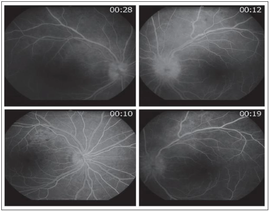 Časná fáze fluorescenčního angiogramu pravého a levého oka v horní polovině, v dolní polovině kontrolní fluorescenční angiografie pravého a levého oka po devíti dnech od zahájení terapie.