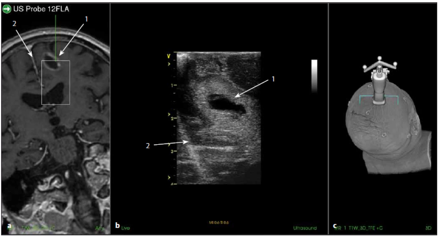 Sonografické a MR zobrazení na přístroji SonoWand.
Fig. 7. Ultrasound and MR images using SonoWand device.