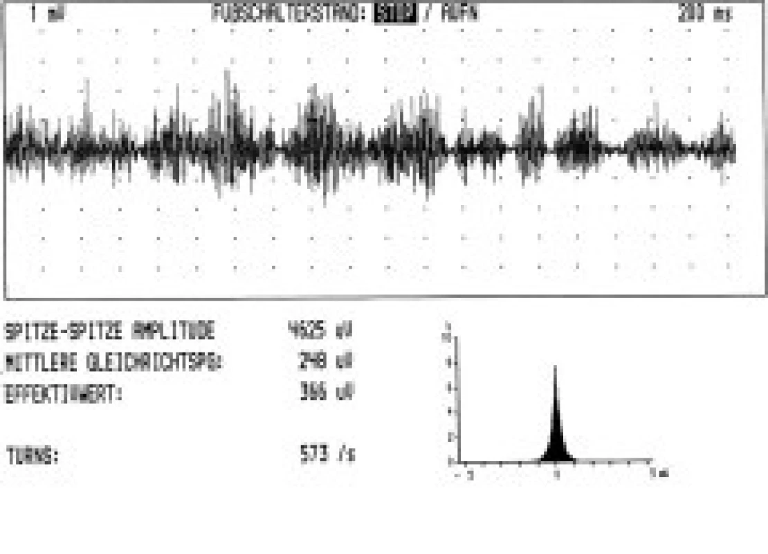 Turns/amplitude analysis u myoklonické formy cervikální dystonie v pokročilé fázi onemocnění (pravostranná torticollis, záznam z m. splenius capitis vpravo, vedoucího svalu, počet turns/sekunda 573).