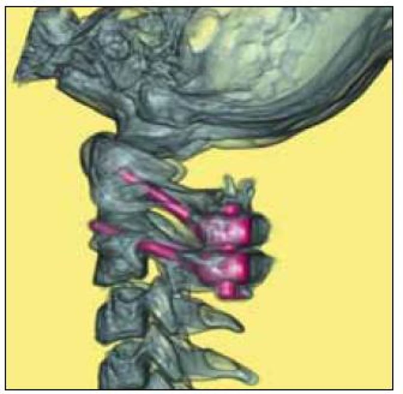 Pacientka s Downovým syndromem.
Pooperační CT 3D snímek krční páteře s fúzí C1–C2.