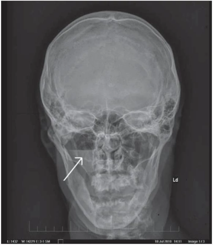 RTG lebky: 47-ročný pacient po úraze páčidlom do tváre pod pravé oko – predná projekcia.
Fraktúra spodiny očnice a hladina voľnej tekutiny v pravej maxillárnej dutine.