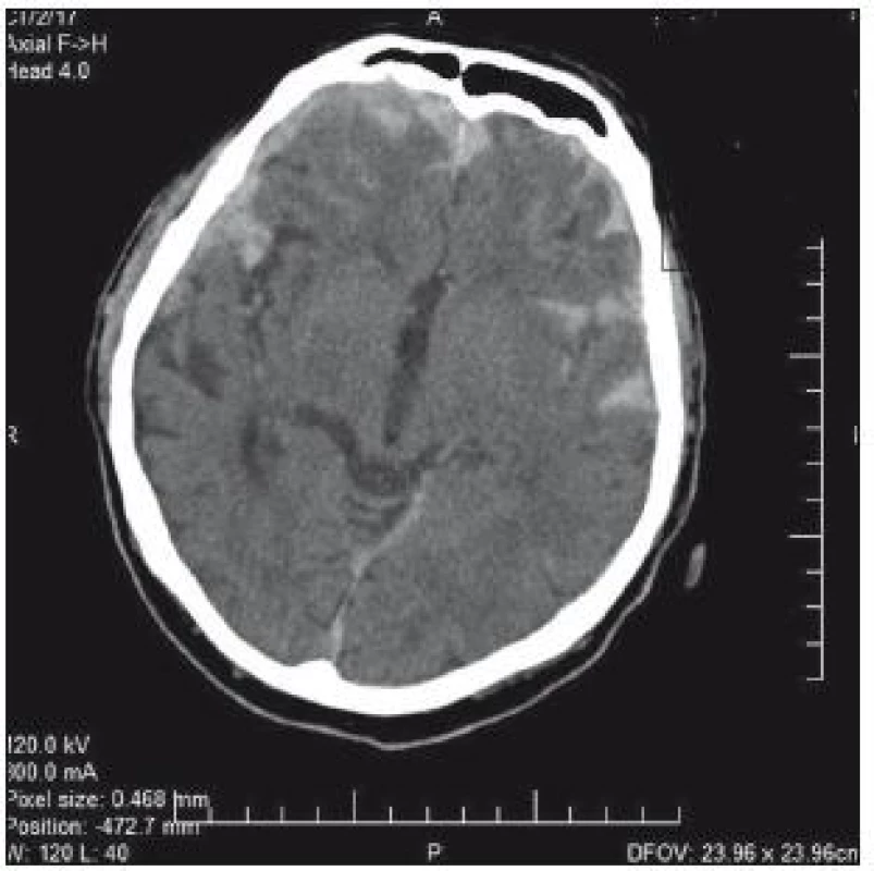 CT mozku: plášťový akutní subdurální hematom frontotemporálně vpravo, traumatické subarachnoidální krvácení.