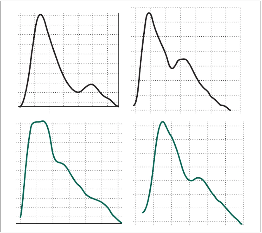 Srovnání křivek periferní pulzové vlny v klidu a za bolestivého prožitku. Na křivce zaznamenané během bolestivého výkonu (dole) je patrno na první vlně rozštěpení 1. kmitu s rozpadem dikrocie, na 2. vlně oploštění a rozšíření 1. kmitu. Oproti kontrole (horní křivka) u obou vln došlo k opoždění nástupu 2. kmitu.