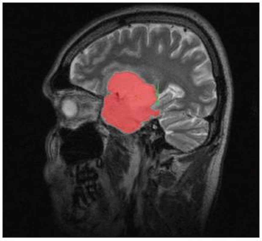 Volumetrie pomocí semiautomatické segmentace: manuální ohraničení oproti objemu mozkové komory (pacientka N.5: pooperační snímek obr. 7a).
