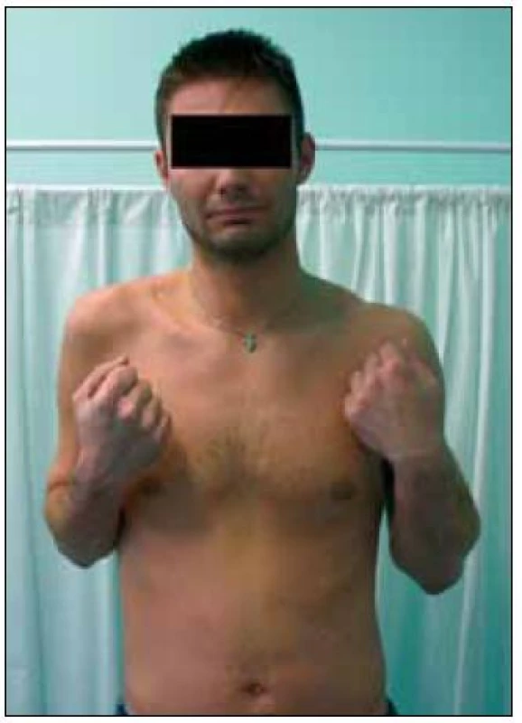 Pacient 14 měsíců po rekonstrukci n. musculocutaneus Oberlinovou technikou z n. ulnaris vpravo.