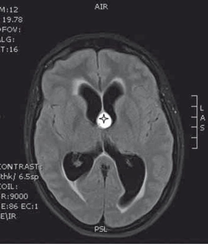 MR vyšetření koloidní cysty (*) s aktivním hydrocefalem.
Fig. 1. MRI of a colloid cyst (*) with active hydrocephalus.