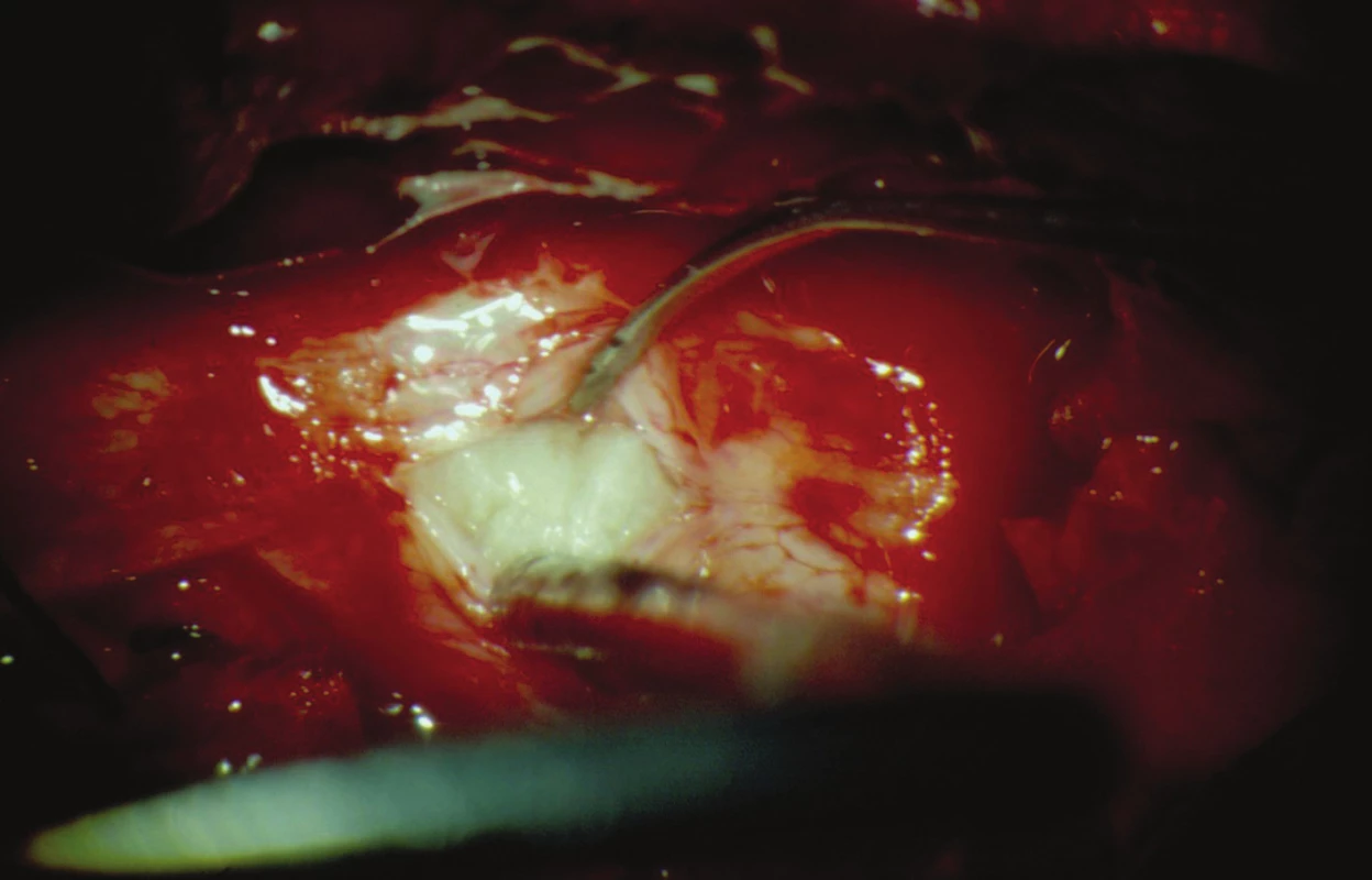 Operační pole (vlevo: kaudálně, vpravo: kraniálně). Podélnou durotomií obnažený intradurální sekvestr.