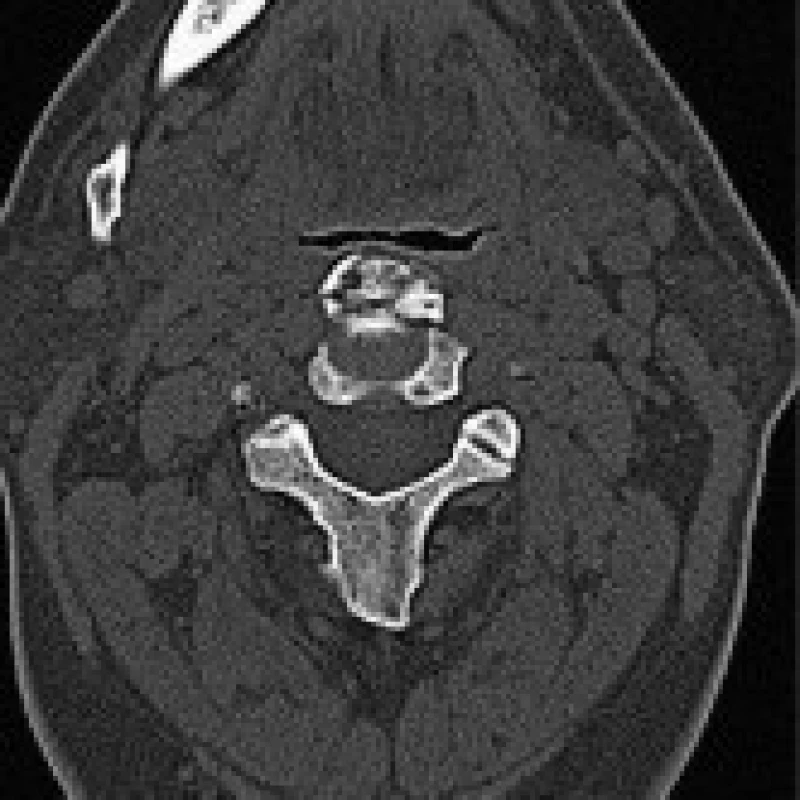 CT krku, rekonstrukce v sagitální (A) a axiální (B) rovině, na kterém je patrná defigurace hypofaryngu (pacient č. 1)