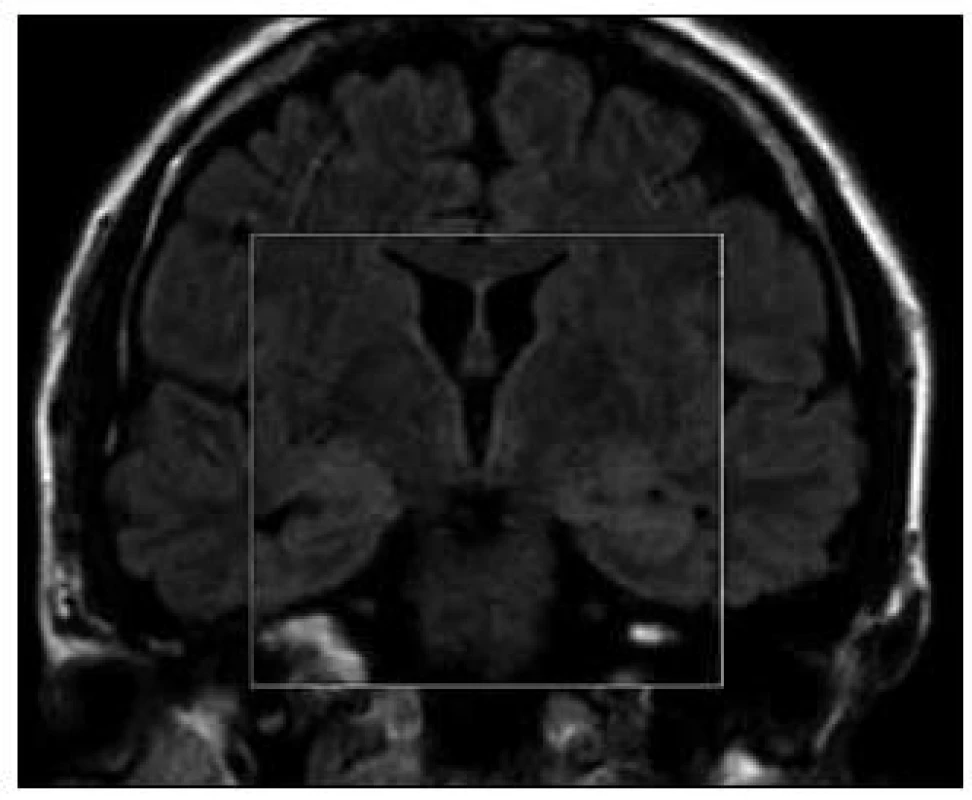 MR mozku – diskrétní zvýšení signálu ve FLAIR (koronární řez) v oblasti mediálních temporálních laloků oboustranně u 2. případu.