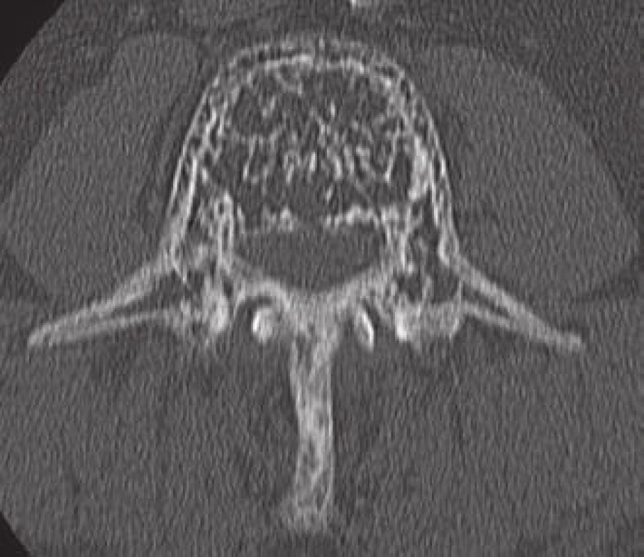 Typický CT příznak AHO v axiálním řezu – „puntíkový vzor“ („polka dot sign“).