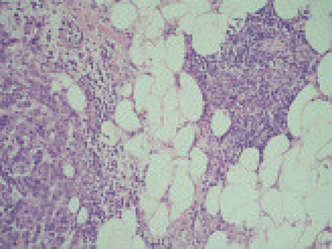 V levé části je zachycena část trabekulárně strukturovaného primárního tumoru, v pravé části v tukové tkáni drobné reziduum tymické tkáně. Barvení HE, zvětšení 200×.