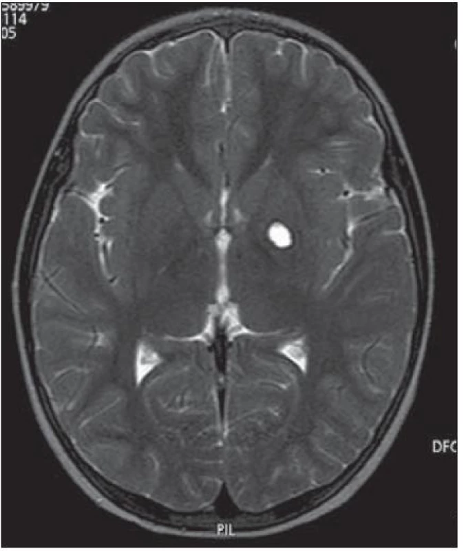 MR mozku, T2 zobrazení, transverzální řez: po léčbě je v levém globus pallidus pseudocysta vyplněná mokem bez patologického sycení (remise).