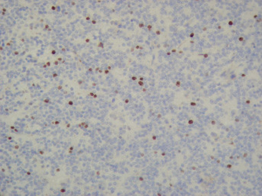 Imunohistochemické barvení na MIB-1 v jádrech buněk nádoru z druhé resekce s 20% pozitivitou.