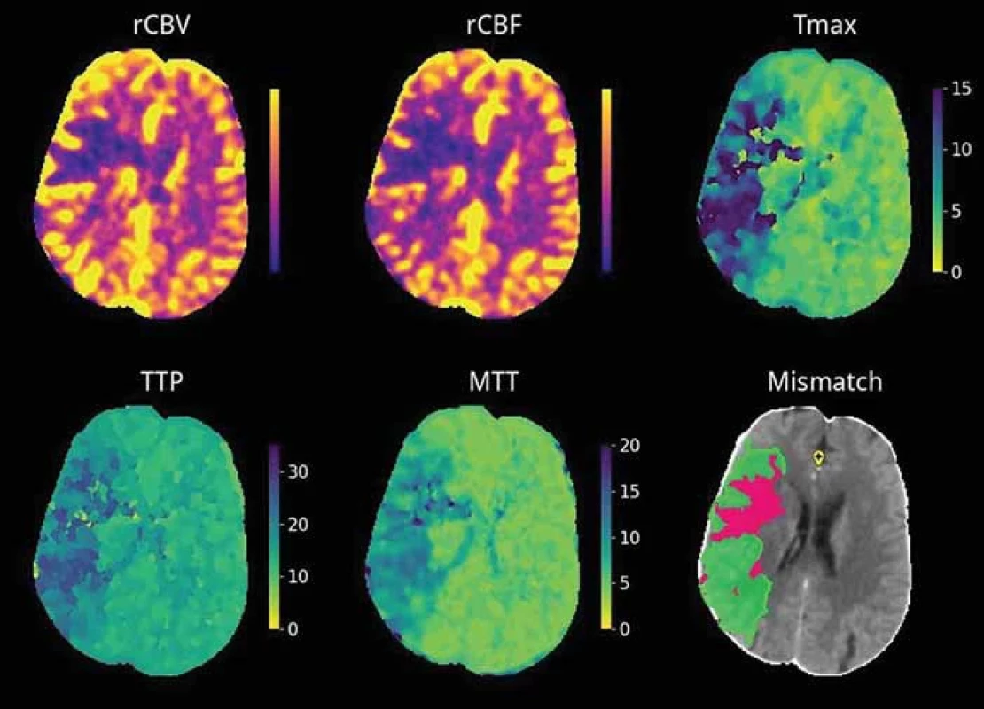 Perfúzne mapy vygenerované softvérom e-CTP Brainomix® zobrazujú hypoperfúziu v povodí arteria cerebri media vpravo, objem jadra je 24 ml, objem penumbry 102 ml, relatívny „mismatch“ je 81 %. Nález je indikovaný k endovaskulárnej liečbe.