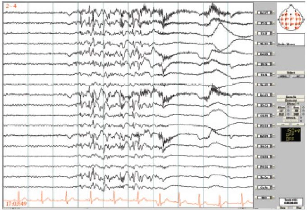 Kazuistika PMA. Nepravidelné generalizované SW/PSW a pomalé vlny, většinou do 5 sekund trvání, provázené jedním nebo několika záškuby m. depressor anguli oris, nepravidelně či rytmicky. Longitudinální zapojení, LF 0,53 Hz, HF 70 Hz.