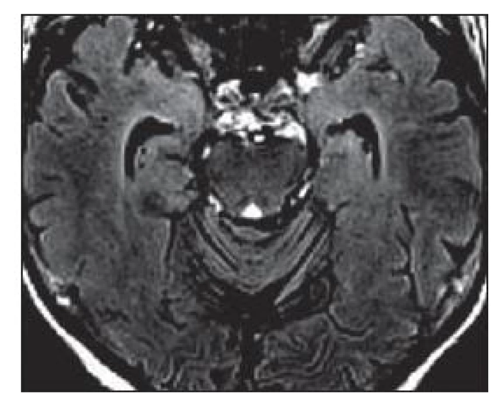 Charakteristický MR obraz limbické encefalitidy.