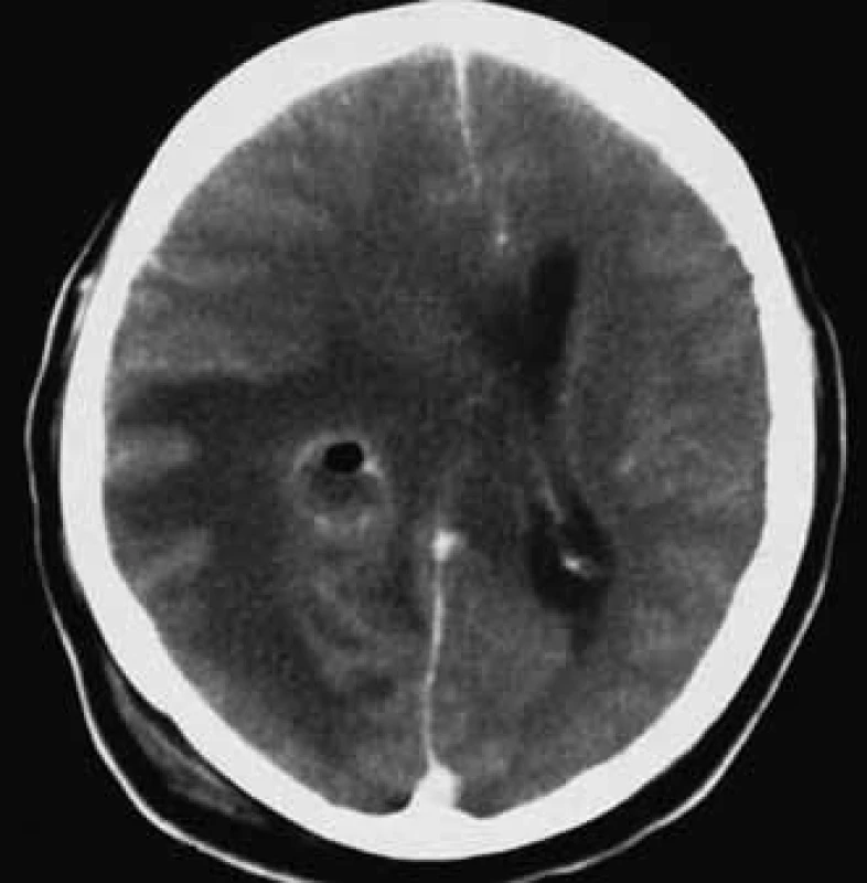 CT mozku provedené po klinické deterioraci nemocného ukazuje progresi edému a středočárového přetlaku. V abscesové dutině, po evakuaci parciálně zkolabované (10 × 17 × 10 mm), je patrné nevelké množství vzduchu.