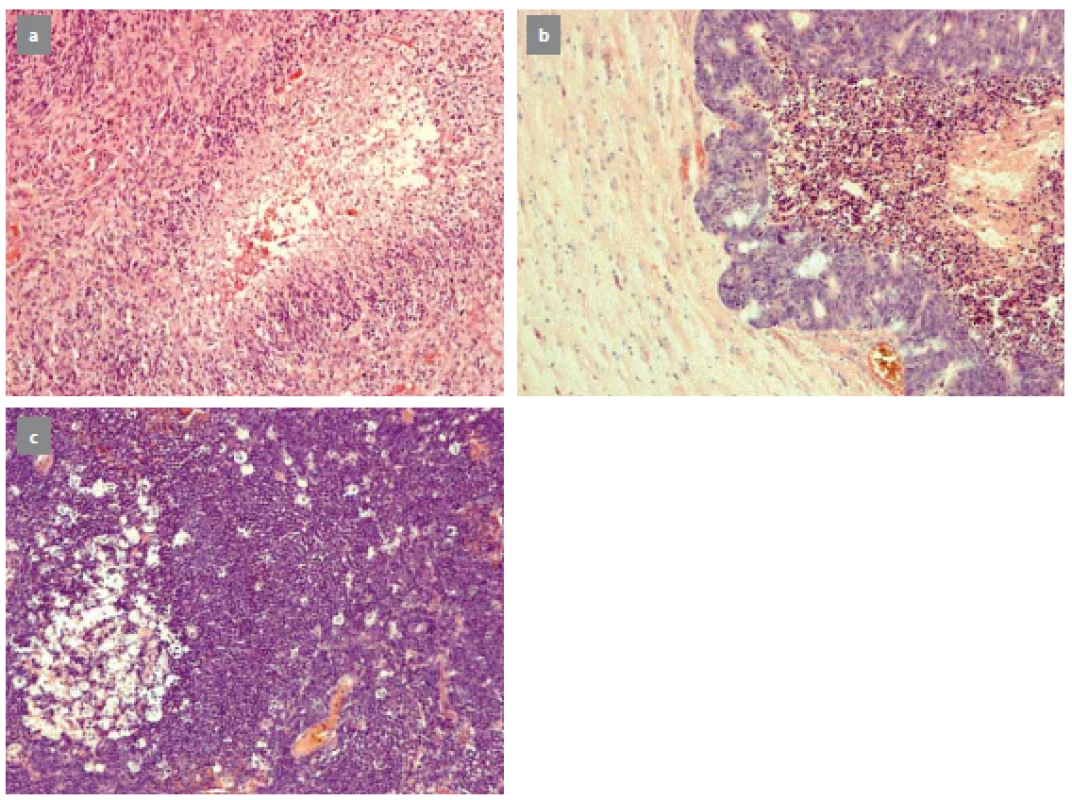 Typický nález glioblastoma multiforme (a), metastáza karcinomu rekta (b), primární lymfom CNS (c).
Fig. 1. A typical image of glioblastoma multiforme (a), metastasis of carcinoma of rectum (b), primary CNS lymphoma (c).