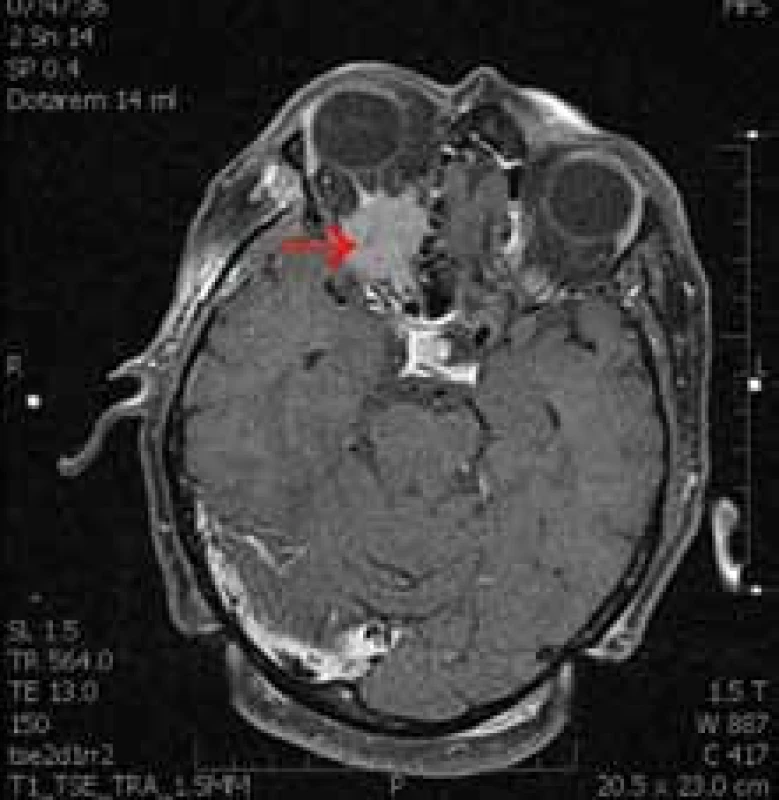 MR pravé orbity, T1 vážený obraz, axiální řezy u 57leté pacientky s meningeomem pochvy zrakového nervu s exofytickým růstem, resekce před třemi lety, klinicky amauróza. 