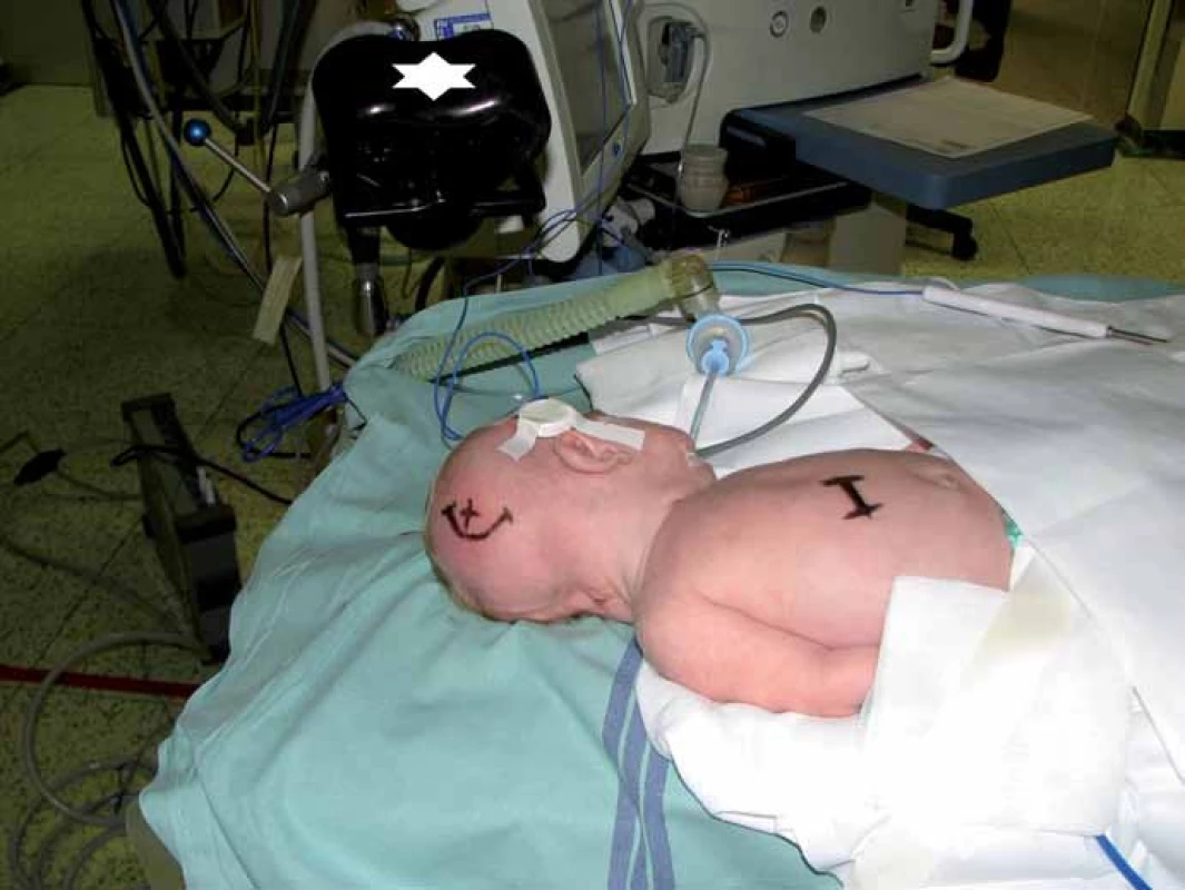 Dítě v poloze před zavedením VP drenáže. Referenční senzor nalepen na pravém spánku, emitor označen hvězdičkou.