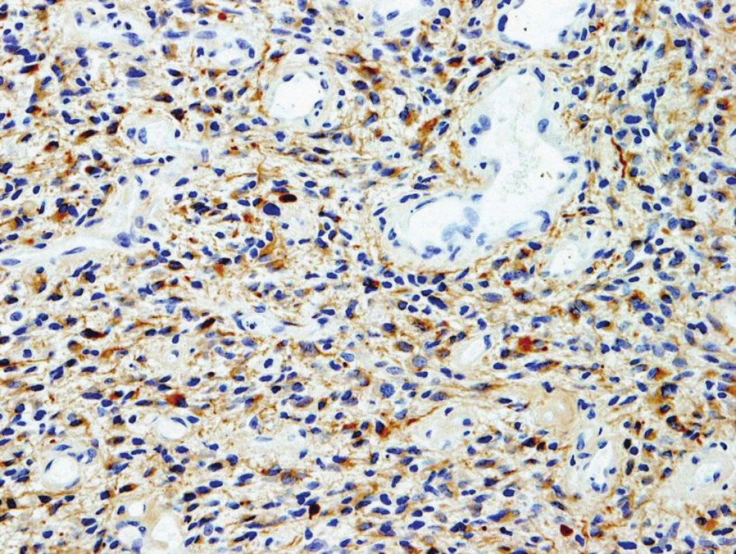 Na histologickém preparátu je zobrazena pozitivní reakce (hnědé zbarvení) nádorových buněk multiformního glioblastomu při imunohistochemické reakci proti gliovému fibrilárnímu acidickému proteinu (GFAP). Zvětšeno 100×.