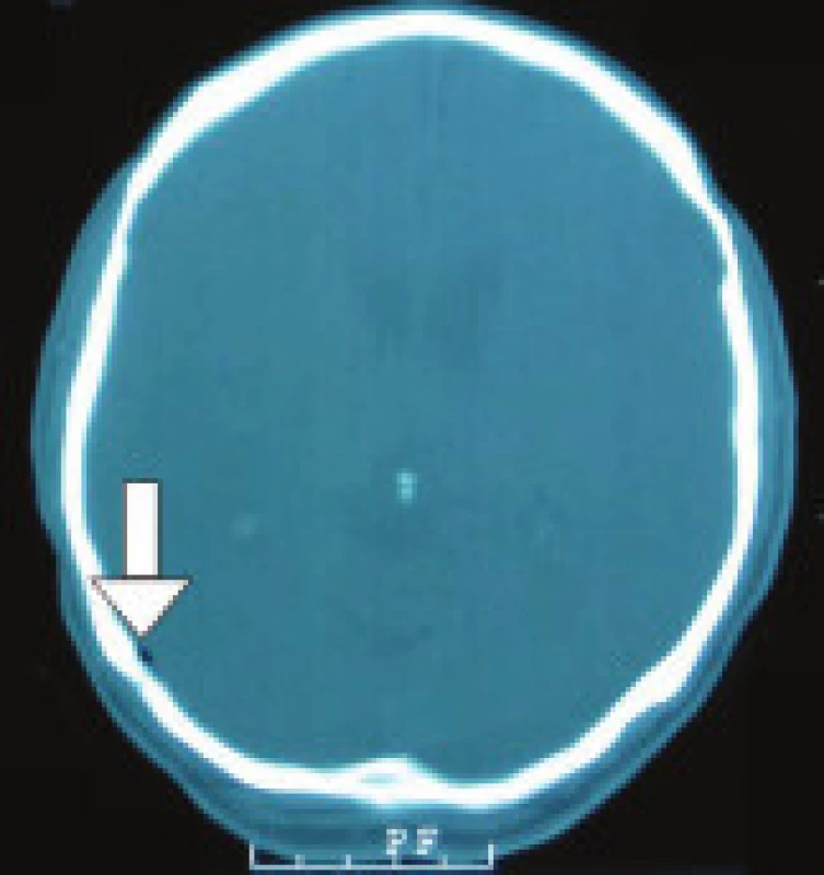 Kauzuistika 1: CT mozku v den úrazu, kostní okno, axiální řez, patrna přítomnost vzduchu parietookcipitálně vpravo (nepřímá známka laterobazálního poranění).