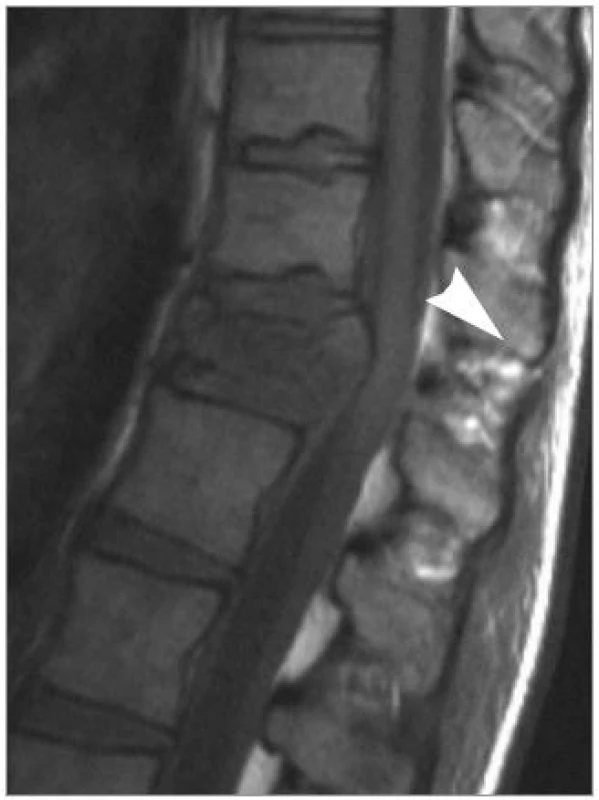 MRI v T1-váženém zobrazení v sagitální rovině ve střední čáře. Bílá šipka označuje diskrétní defekt v supraspinózním vazu Th11/Th12. Zlomenina obratlového těla Th12 je tříštivá s dislokací do kanálu páteřního.