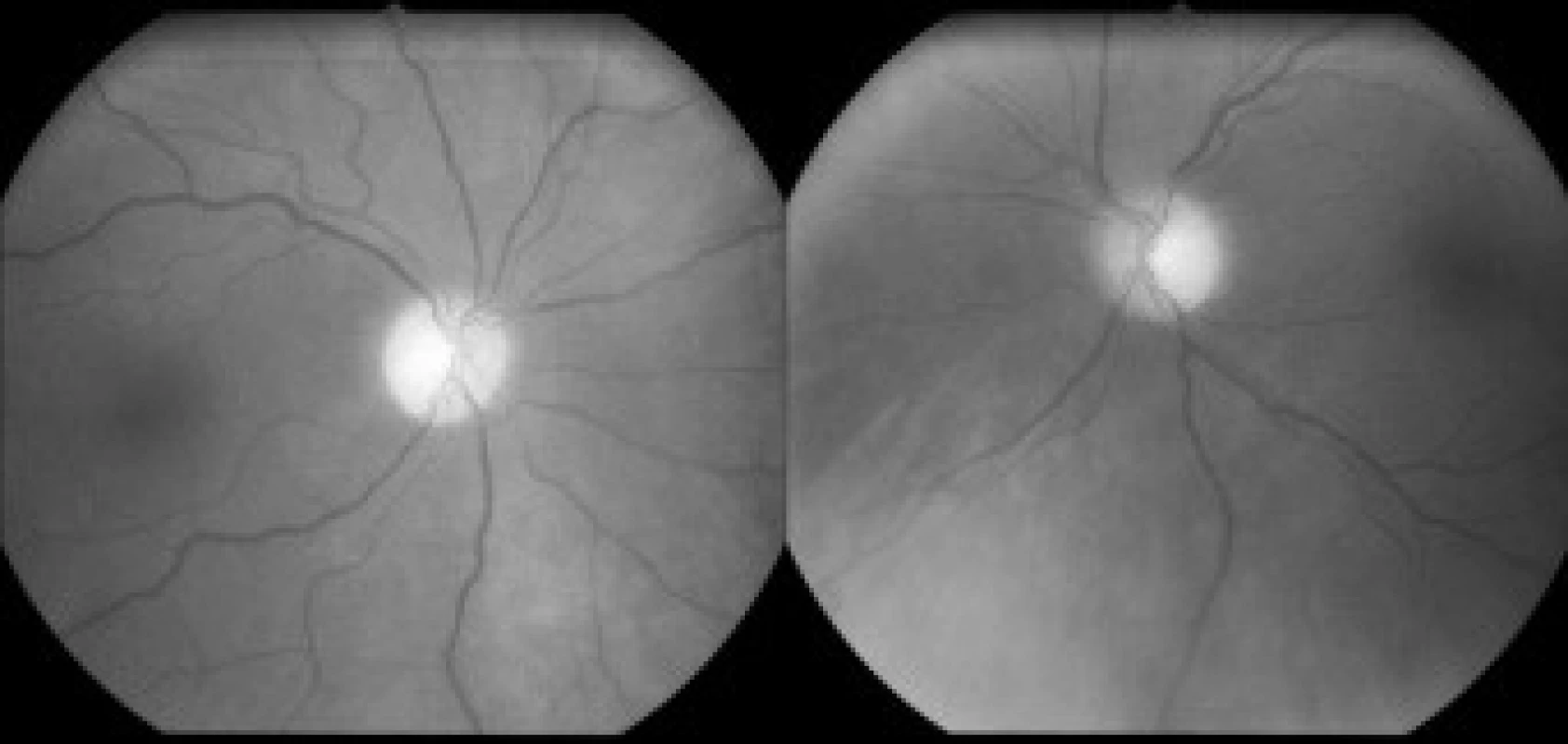 Na snímku očního pozadí jsou patrné ostře ohraničené bledé papily – obraz odpovídá pokročilé atrofii zrakového nervu obou očí.