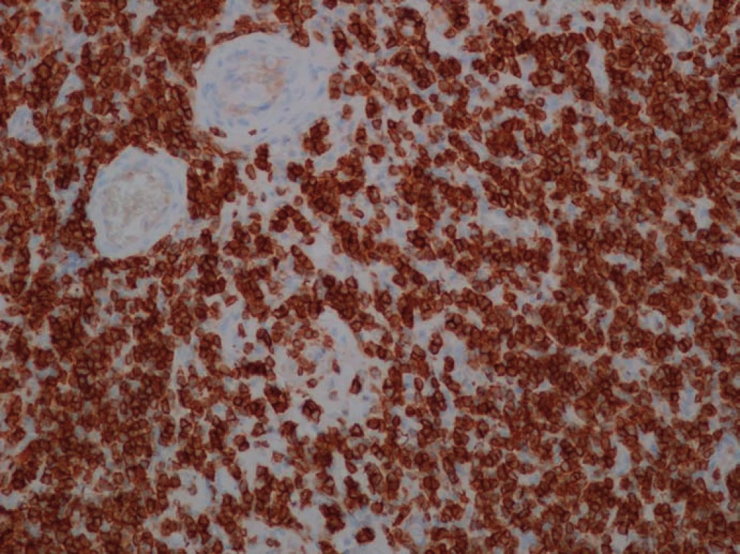 Imunohistochemický průkaz antigenu CD20, znázorňující četné B lymfocyty.
