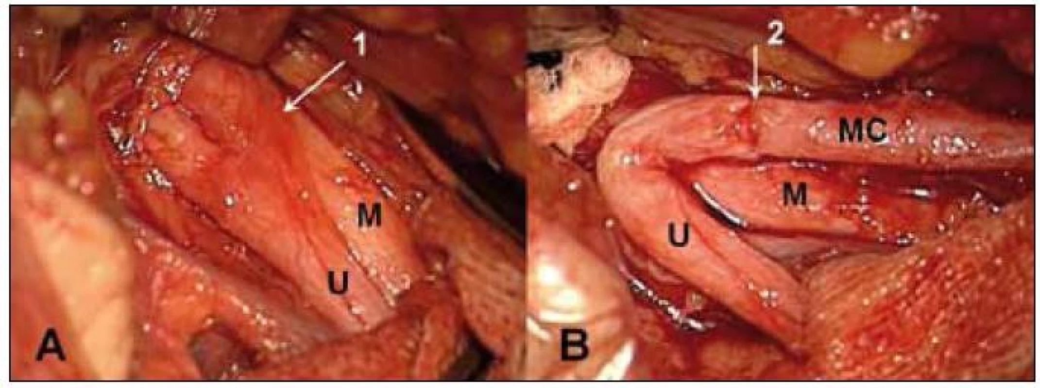 Sutura n. musculocutaneus (MC) na kořen C5 pomocí vaskularizovaného štěpu z n. ulnaris (U) při avulzi dolních kořenů. A – n. ulnaris s cévní stopkou (1), B – stav po sutuře štěpu na n. musculocutaneus (MC) (2), M – n. medianus.