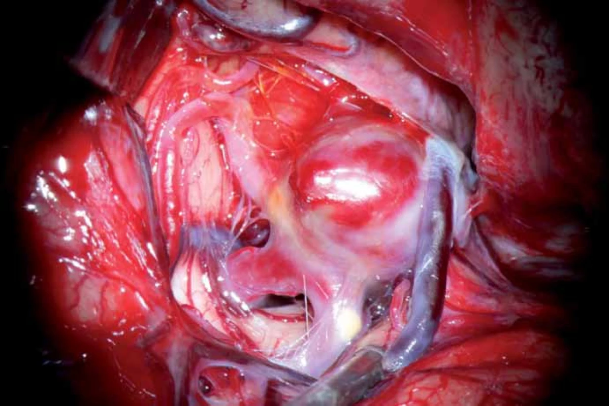Peroperační nález aneuryzmatu.
Krček není vydefinován a splývá se širokým fundem.