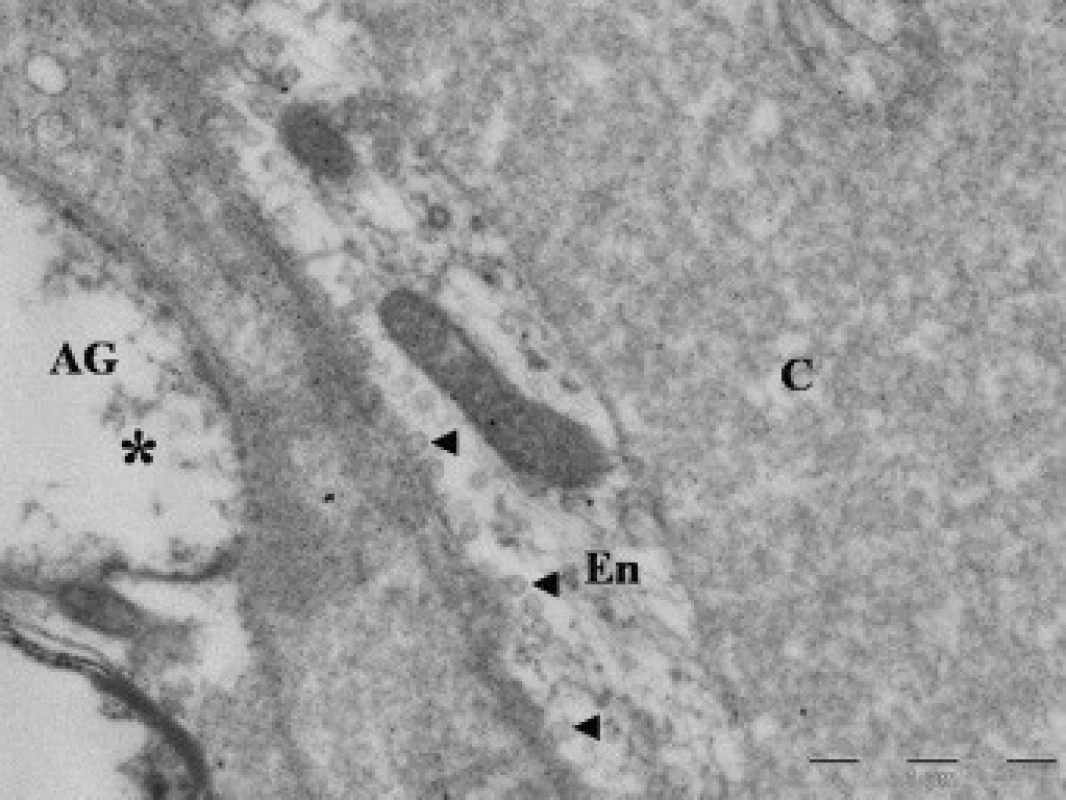 Elektronová mikroskopie kontuzního ložiska u pacienta (soubor II), zobrazení lumen kapiláry (C). Na řezu zachycena endotelie (En) s pinocytotickými vakuolami (◄ ); výběžky astroglie (*).