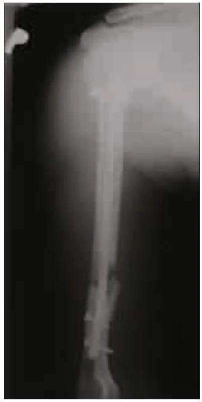 Rentgenový snímek pravé pažní kosti po zajištěném hřebování.