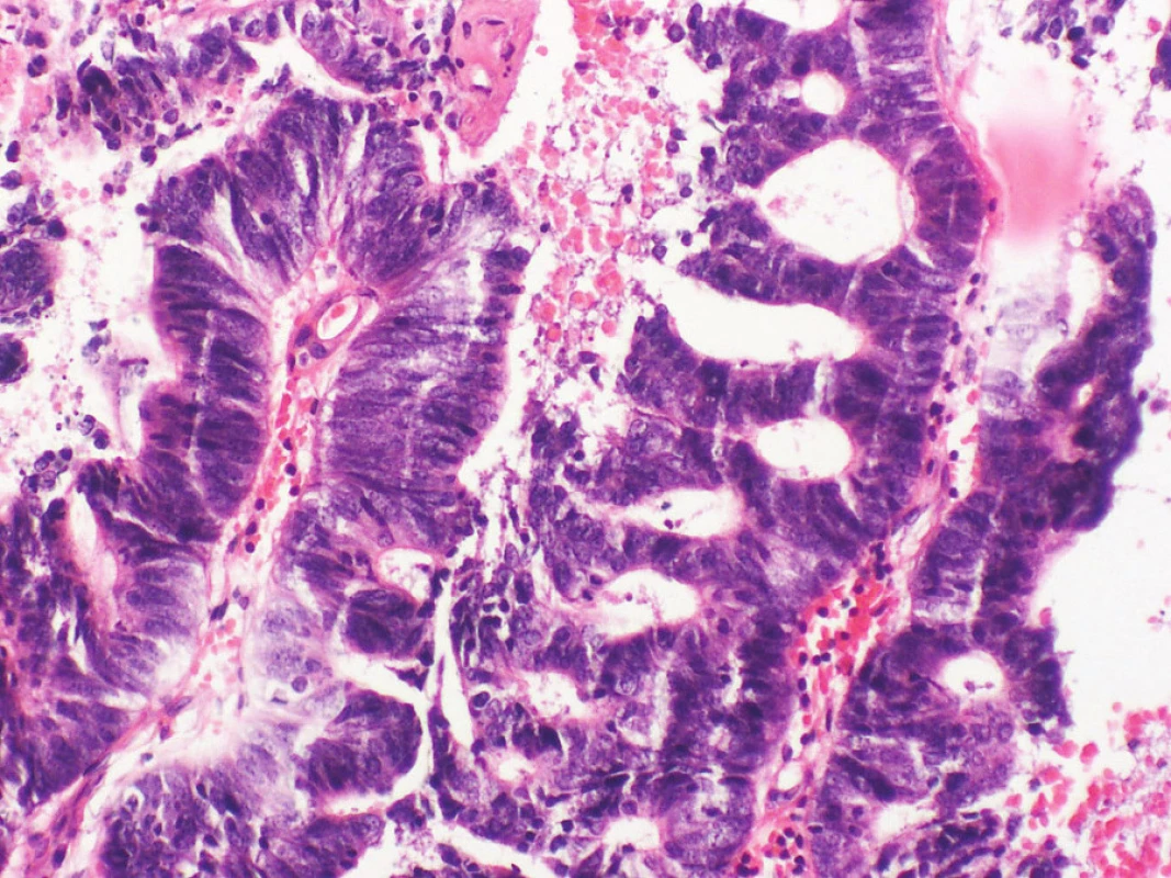 Histologické vyšetření metastázy adenokarcinomu do míchy. Barvení hematoxylin-eosin, zvětšeno 200krát.