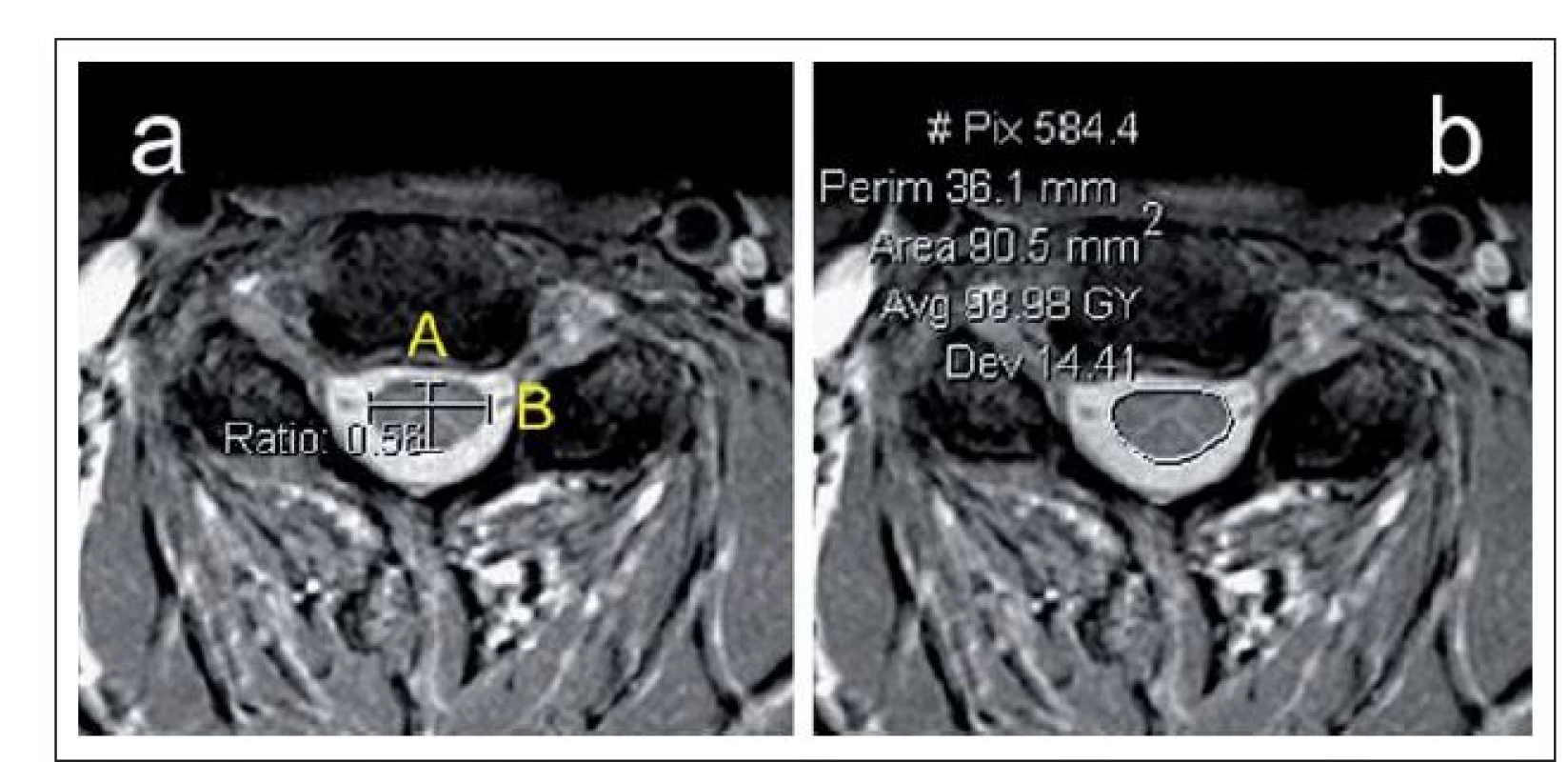 a,b) Axiální T2 zobrazení MR krční páteře s ukázkou měření kompresního poměru
(a) a plochy míchy (b).