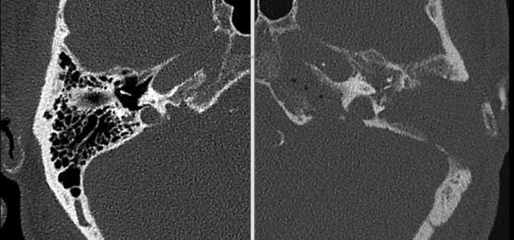 Kazuistika 1 – CT spánkových kostí axiální řezy, stav po antromastoidektomii vlevo.
Osteolytické změny hrotu pyramidy (hvězdičky).