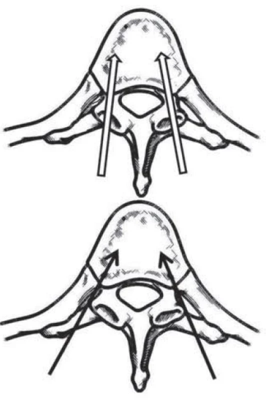 Schematické znázornění transpedikulárního (nevyplněné šipky) a latero-extrapedikulárního přístupu (černé plné šipky) k vertebroplastice v hrudní páteři.

