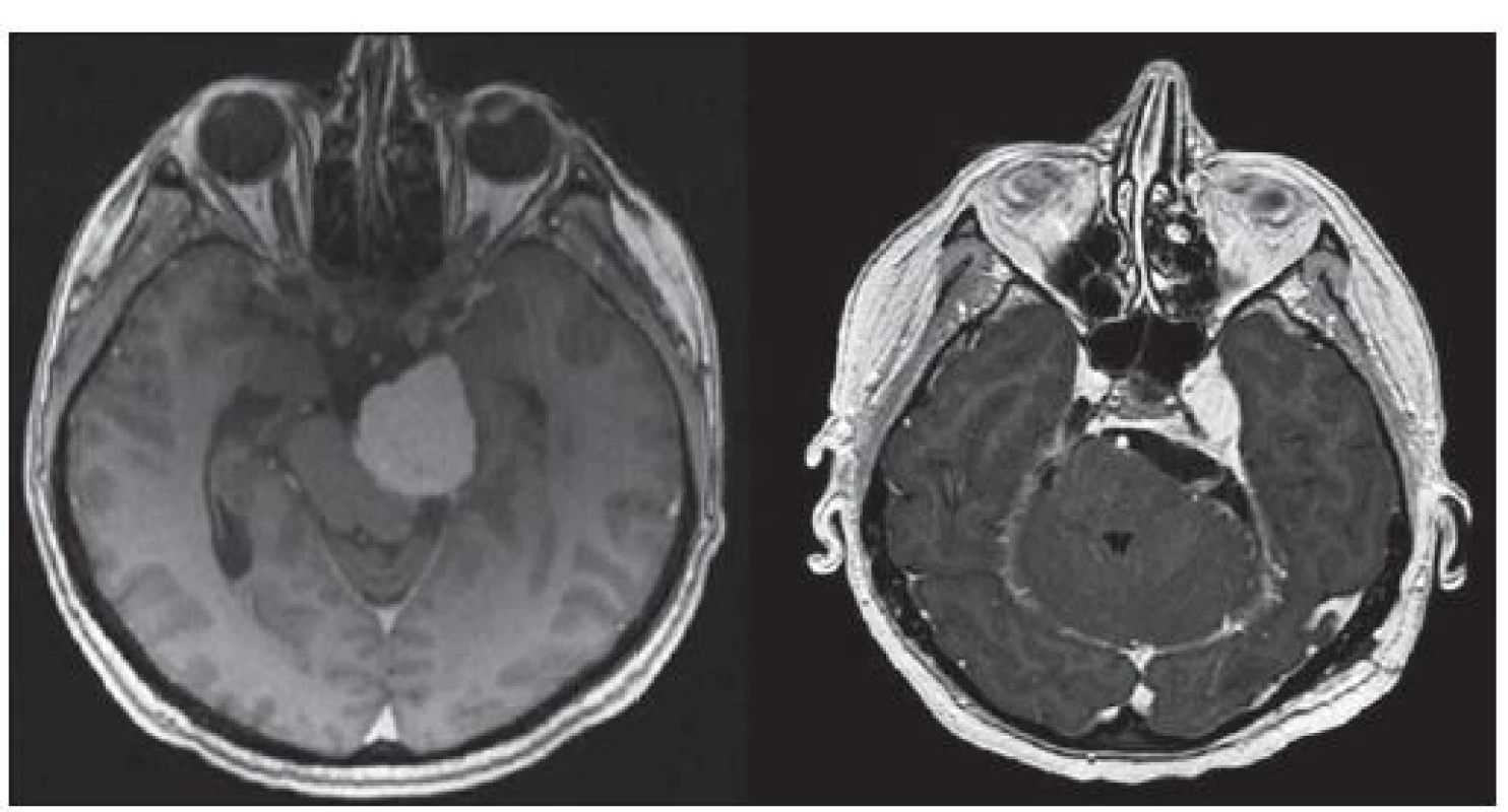 Předoperační a pooperační snímky petrokliválního meningeomu.