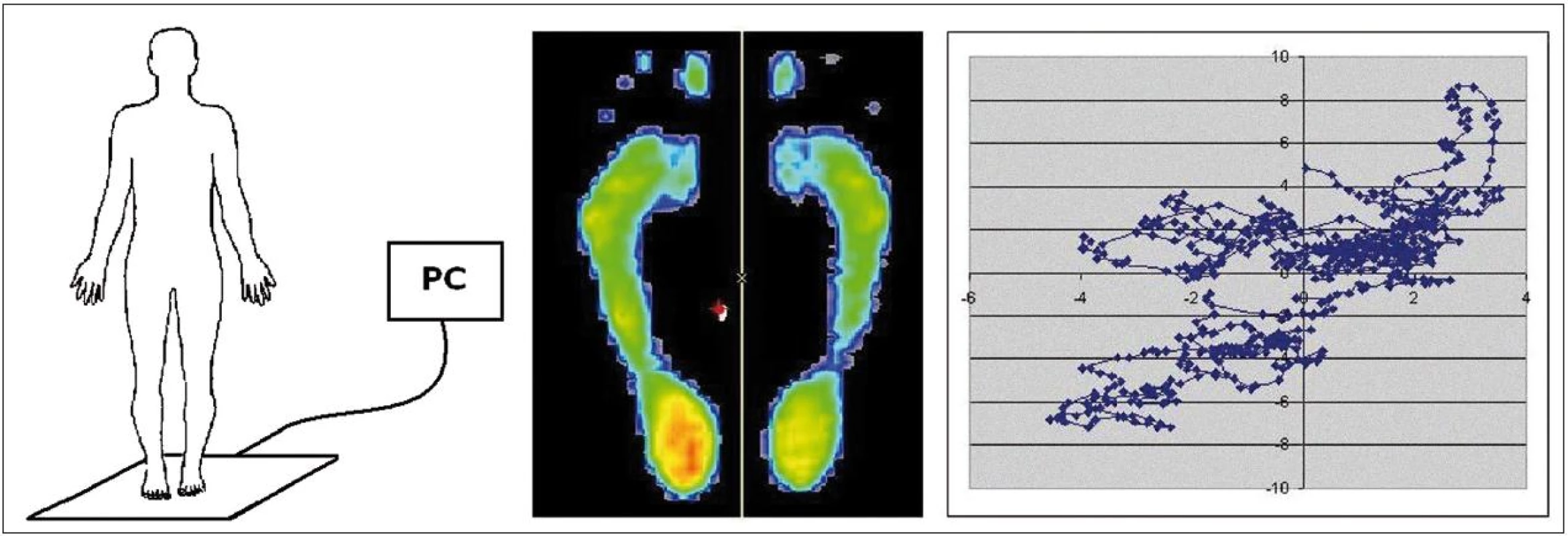 Schéma použití posturografické desky FootScan včetně projekce zátěže chodidel a zobrazení změn průmětu pomyslného těžiště – COP (Centre Of Pressure) do podložky v čase.