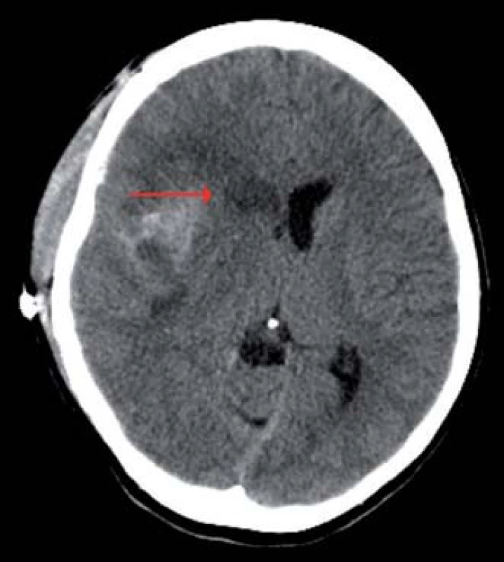 Výpočetní tomografie mozku, transverzální projekce, expanzivně se chovající lehce prokrvácená ischemie v povodí ACM vpravo zasahující až do oblasti nucleus caudatus (červená šipka), přetlak střední čáry doleva.