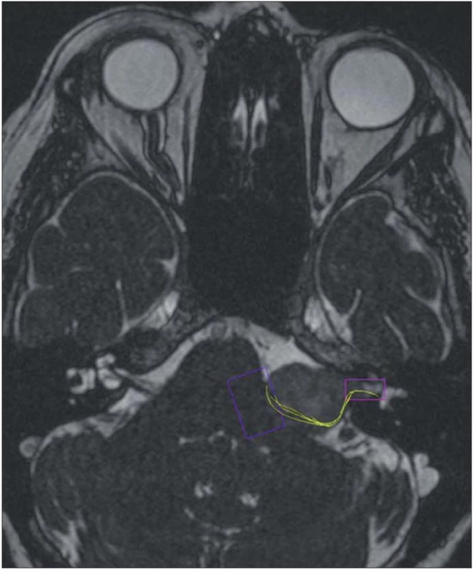 Vestibulární schwannom vlevo s dorzální polohou faciálního nervu v DTI zobrazení.